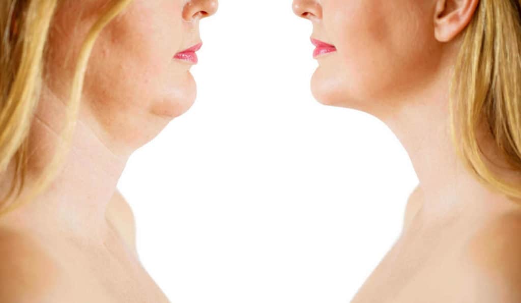Double Chin treatment Huddersfield before and after results