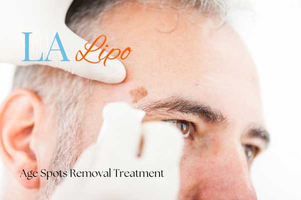 What Are the Most Effective Treatments for Age Spots Huddersfield?