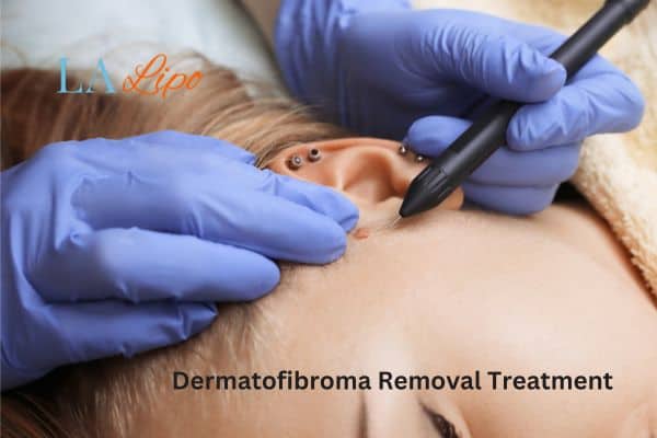 Dermatofibroma Removal Treatment Huddersfield