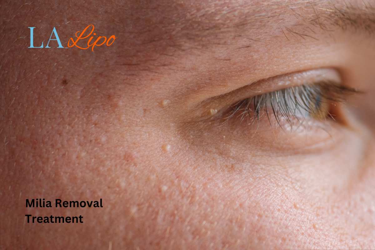 Cryopen Milia Removal: Is It the Easiest and Safest Option Huddersfield?