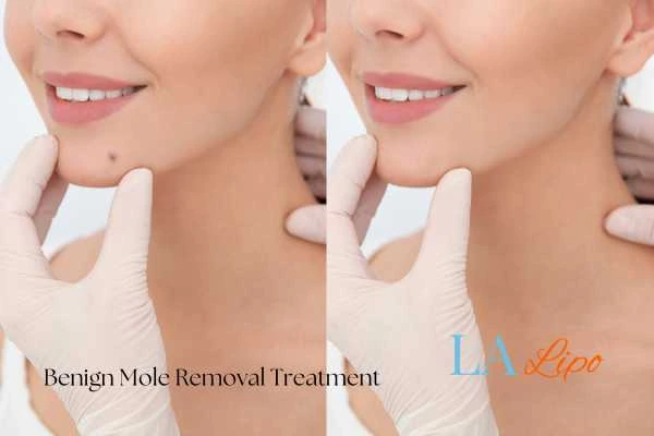 woman's before and after mole removal Huddersfield results