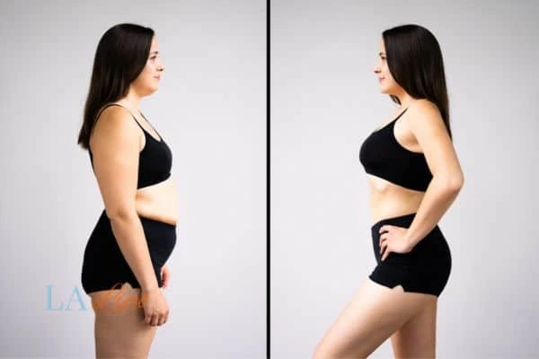 image of woman before and after results of LA-EMS Body Sculpting Huddersfield to help treat Diastasis recti