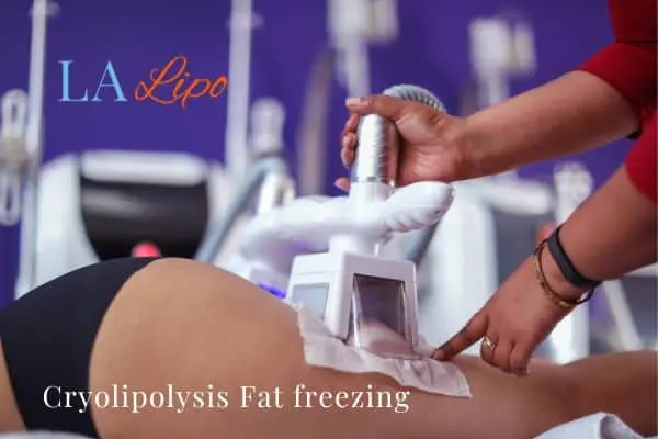 women getting fat freezing Huddersfield