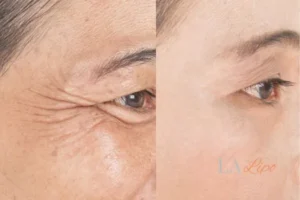 Before and after results of woman - HI-fu wrinkles reduction treatment Huddersfield