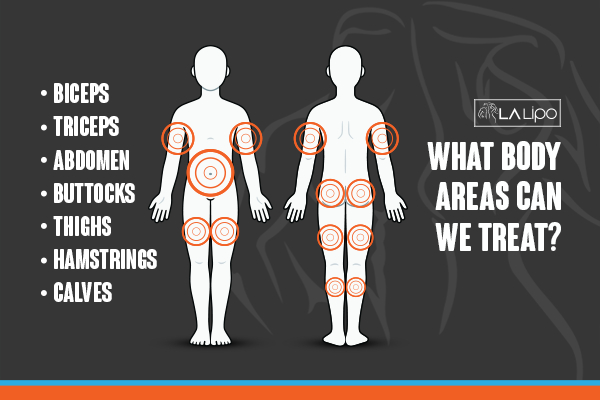 Graphic to show areas you can have LA-EMS Body Sculpting Huddersfield treatment.