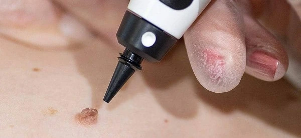 skin tag removal using cryopen Huddersfield