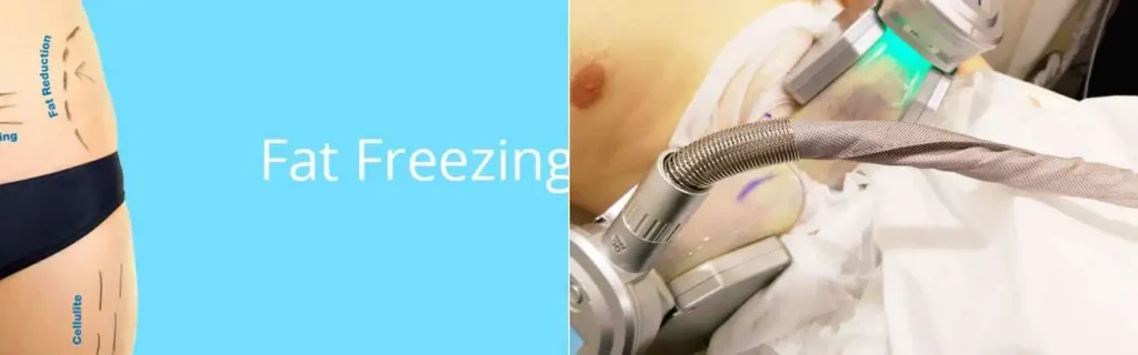 Fat freezing Huddersfield on multiple areas of the body