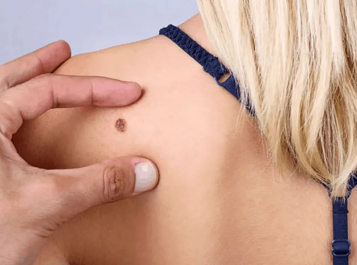 woman having mole removal Huddersfield consultation before treatment.