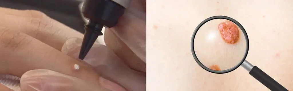Cryopen for mole removal Huddersfield - speak to our team today!