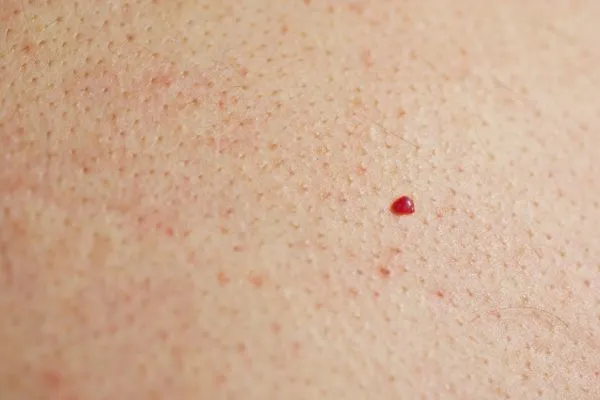 close up of a cherry angioma Huddersfield