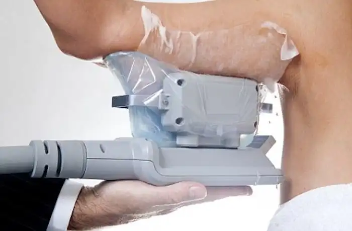 Picture of fat freezing Huddersfield on the upper arms.
