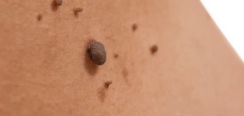 image of a skin tag Huddersfield