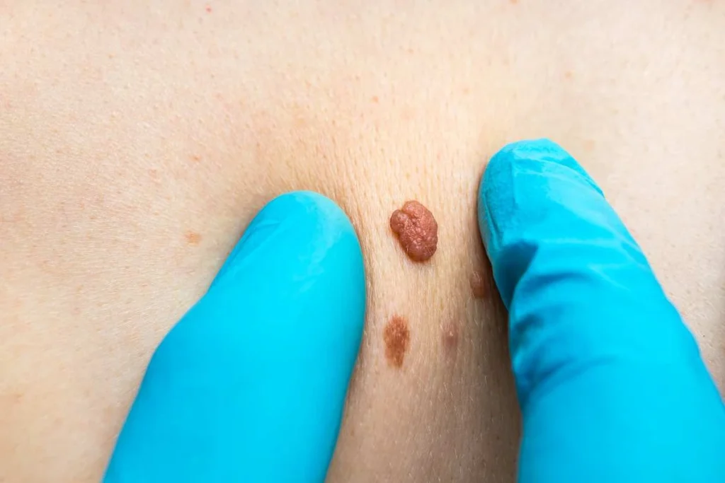 Consultant examining a skin tag Huddersfield