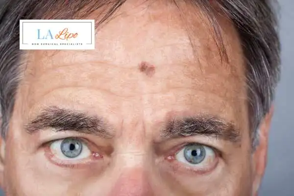 Solar Lentigo Removal Huddersfield image of man with mark on his forehead