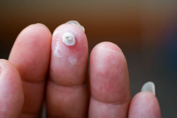 wart on person finger - cryotherapy to treat from LA LIPO Huddersfield