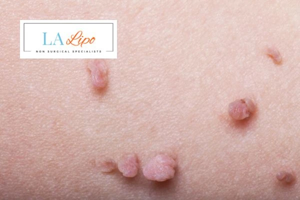 Does cryopen skin tag removal Huddersfield hurt? Find out now call our team today!