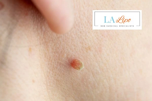 Book skin tag removal Huddersfield today speak to our team now!