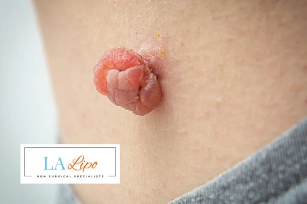 Interested in skin tag removal Huddersfield? Concerned about the pain? Find out more today!