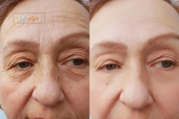The powerful benefits of Morpheus8 Treatment Huddersfield - Call Our team today!