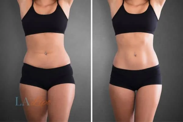 before and after results of non-surgical treatment to help a woman's body image and mental health Huddersfield
