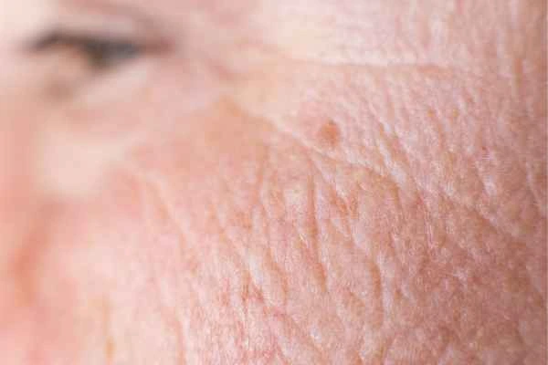 close up picture of a woman's face showing an age spot Huddersfield