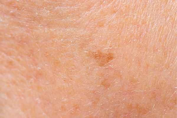 close up picture of age spots Huddersfield