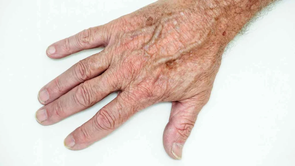 Male hand showing age spot Huddersfield