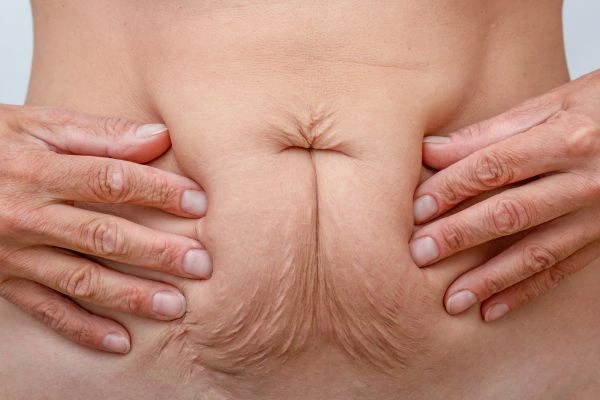 Should I Combine Diastasis Recti Treatment with Body Contouring for Better Results Huddersfield?