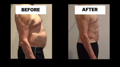 What Symptoms Can Diastasis Recti Cause in Men? Weak Core, Back Pain and Poor Posture Huddersfield